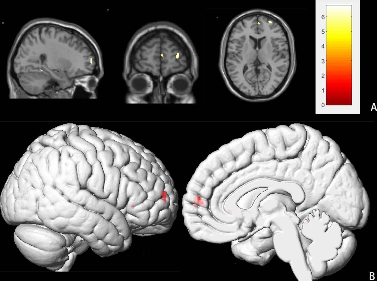Structural and functional changes following brain surgery in pediatric patients with intracranial space-occupying lesions
