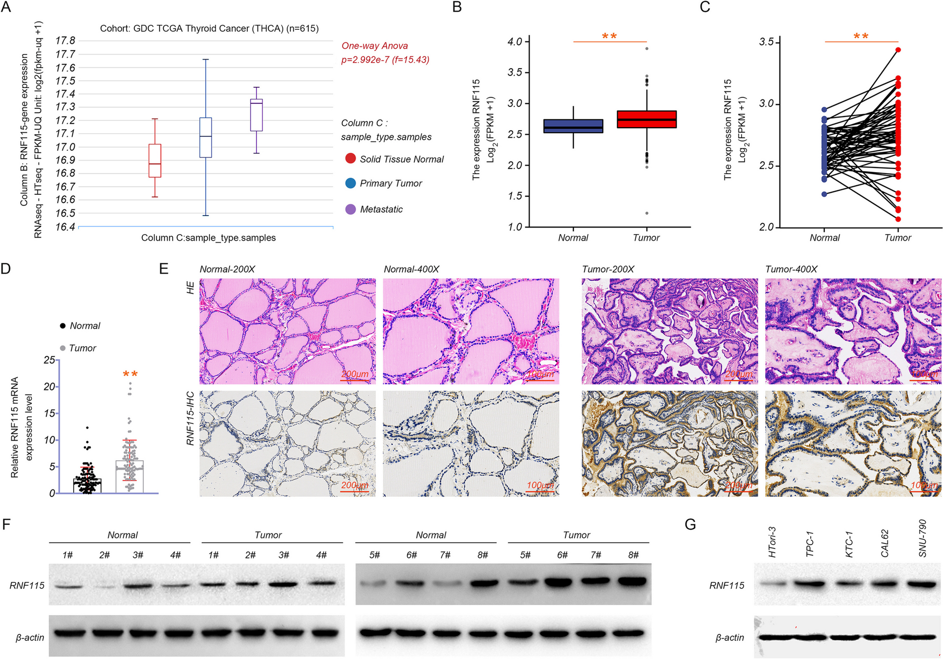 RNF115 aggravates tumor progression through regulation of CDK10 degradation in thyroid carcinoma