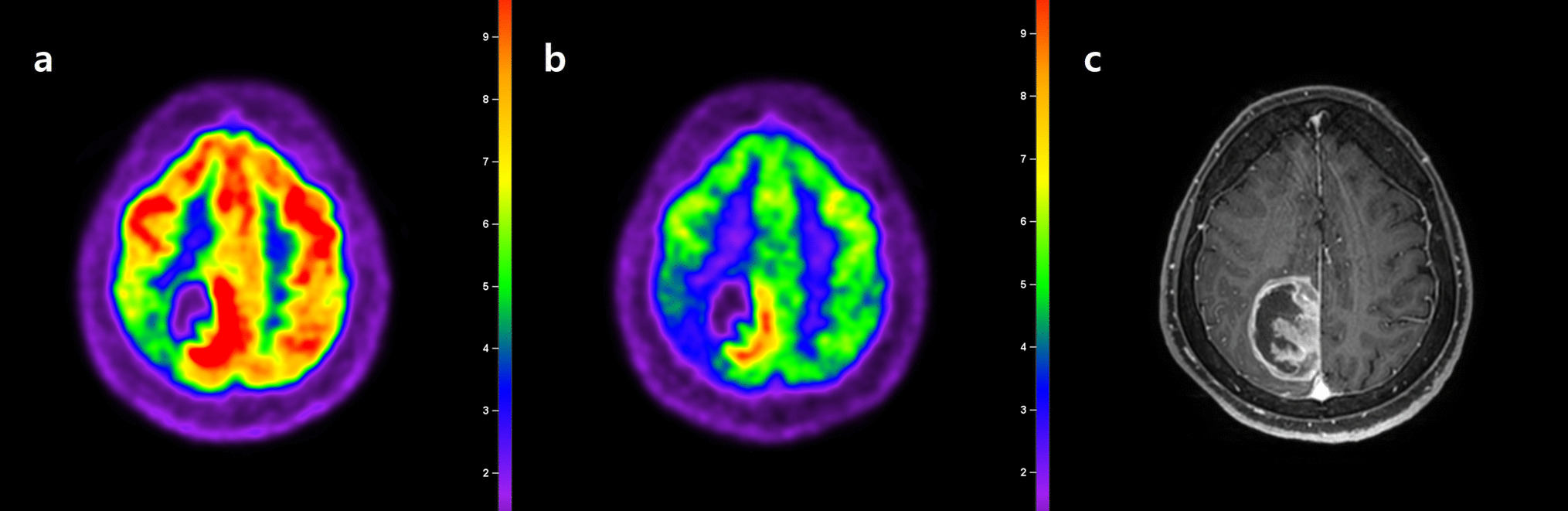 Recent Update on PET/CT Radiotracers for Imaging Cerebral Glioma