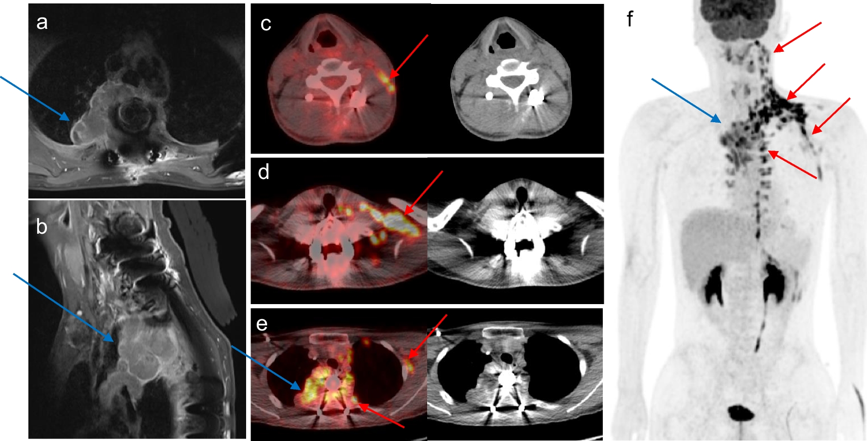 Unilateral Increased Brown Fat Activities on 18F-FDG PET/CT in a Patient with Contralateral Anhidrosis After Surgical Treatment of Metastatic Osteosarcoma in the Upper Thoracic Spine