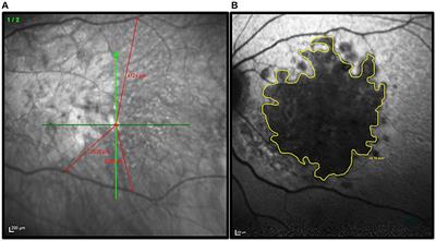 tRNS boosts visual perceptual learning in participants with bilateral macular degeneration