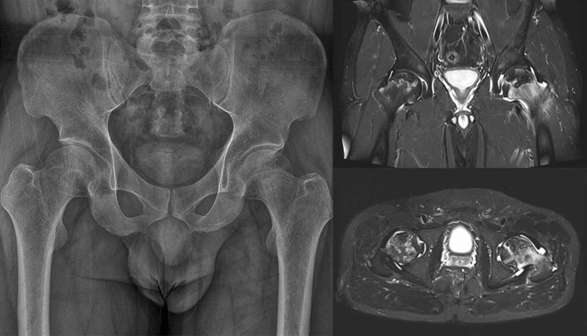 A Very Rare Form of Ceramic Head Fracture in Bipolar Hemiarthroplasty and Total Hip Arthroplasty: Unique Experience and Literature Review