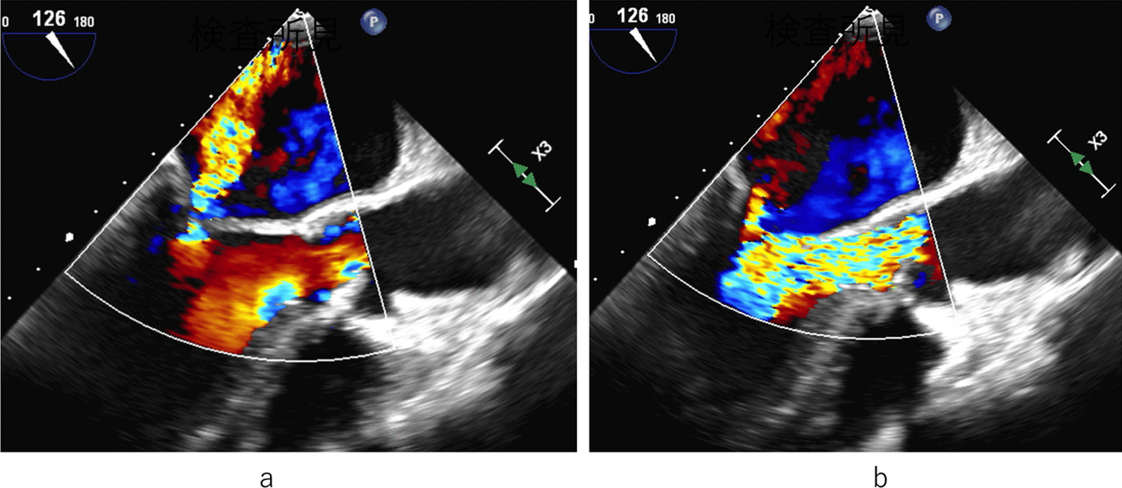 Totally endoscopic concomitant aortic and mitral valve surgery in junctional epidermolysis bullosa: a case report