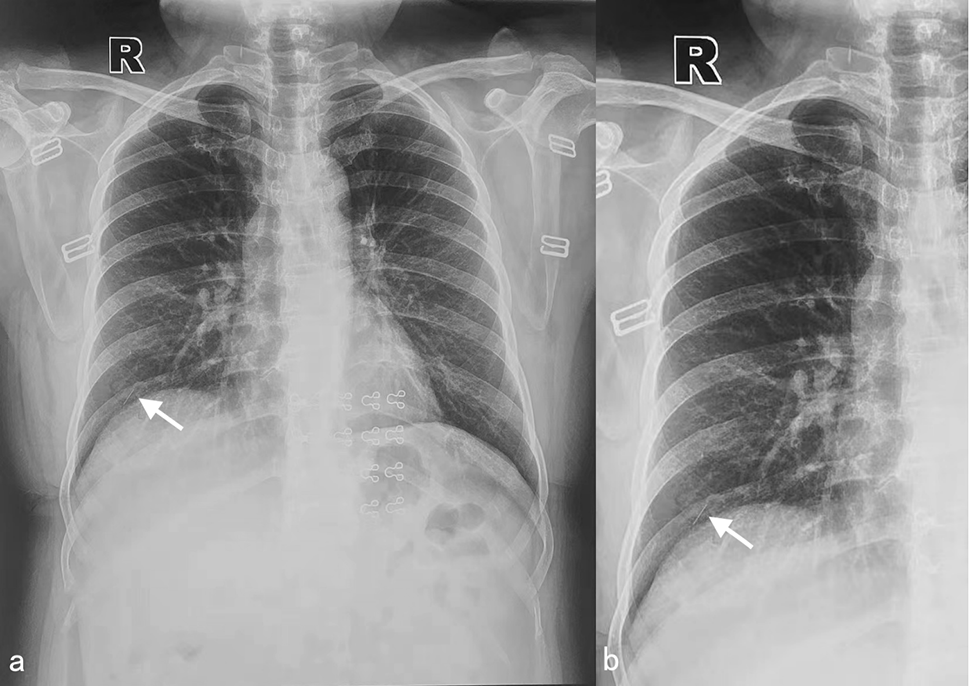 Intrapulmonary migration of a fractured acupuncture needle: a case report