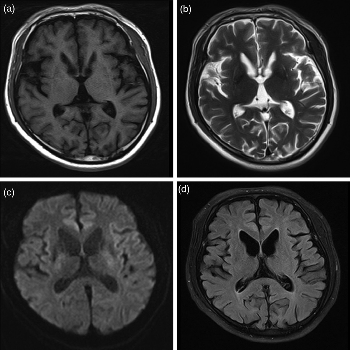 A rare case report of Huntington’s disease with severe psychiatric symptoms as initial manifestations