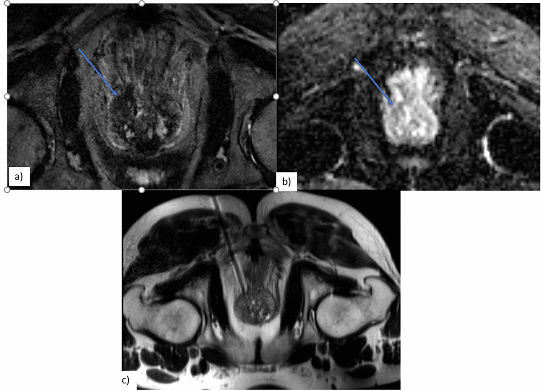 3.0-T MR-guided transgluteal in-bore-targeted prostate biopsy under local anesthesia in patients without rectal access: a single-institute experience and review of literature