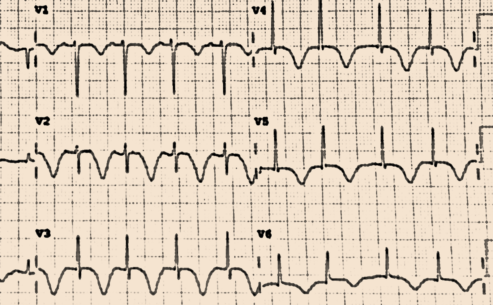 Takotsubo cardiomyopathy in India and its electrocardiography (ECG) comparison to myocardial infarction