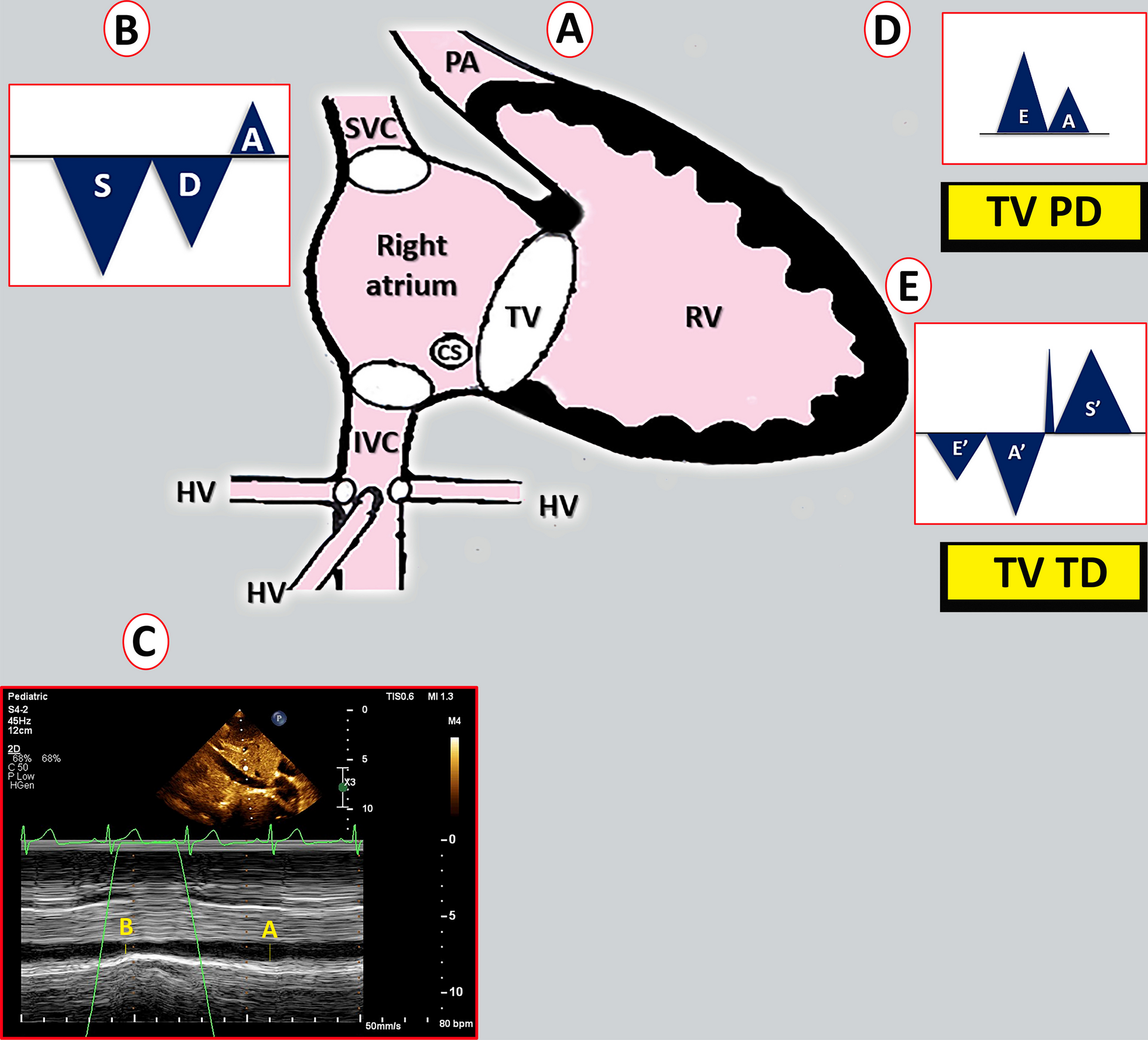 Correlation between echocardiographic estimation of right atrial pressure and invasive measurement of central venous pressure in postoperative pediatric patients with congenital heart disease: a prospective observational study