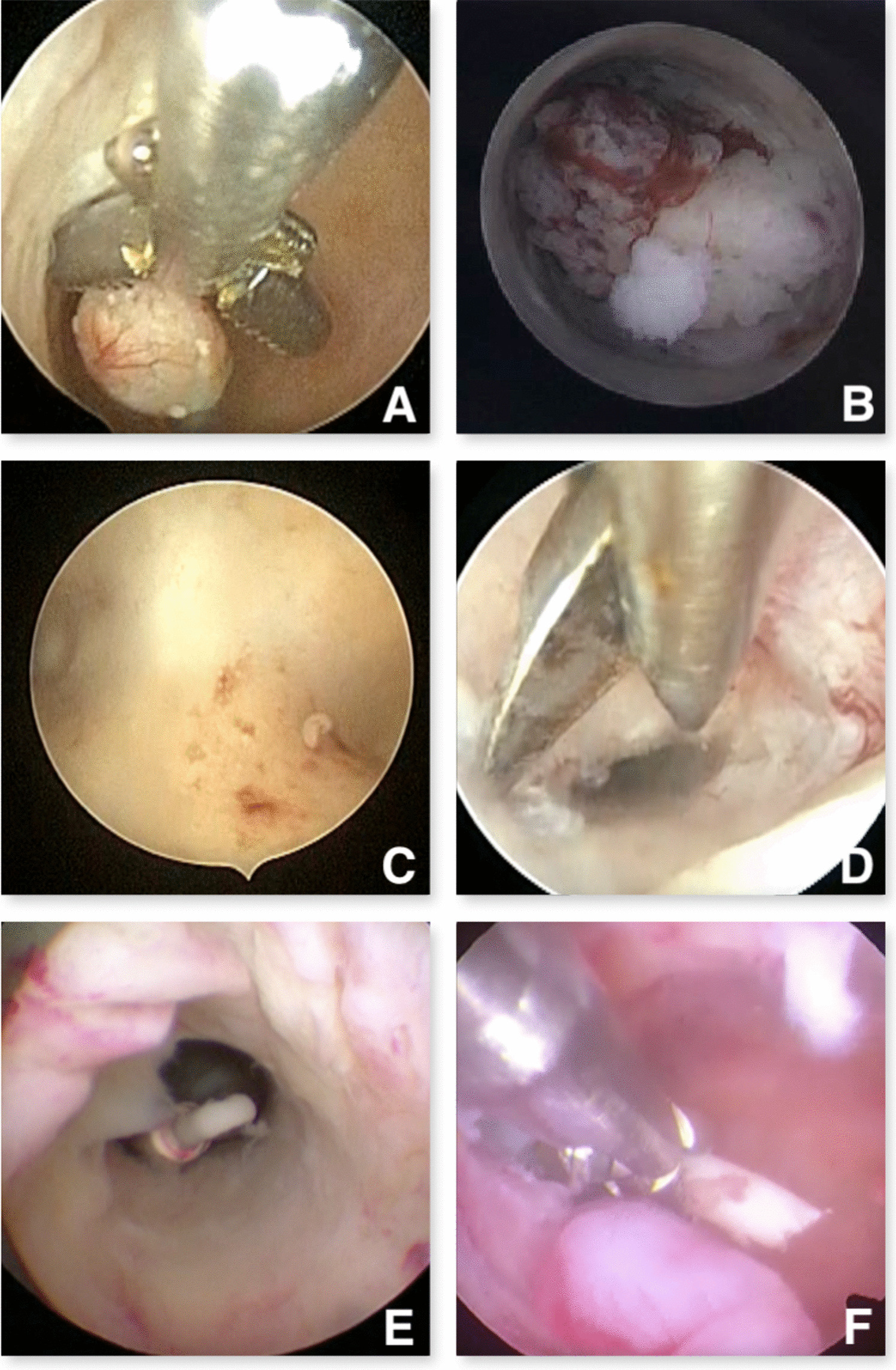 An Overview of Office Hysteroscopy