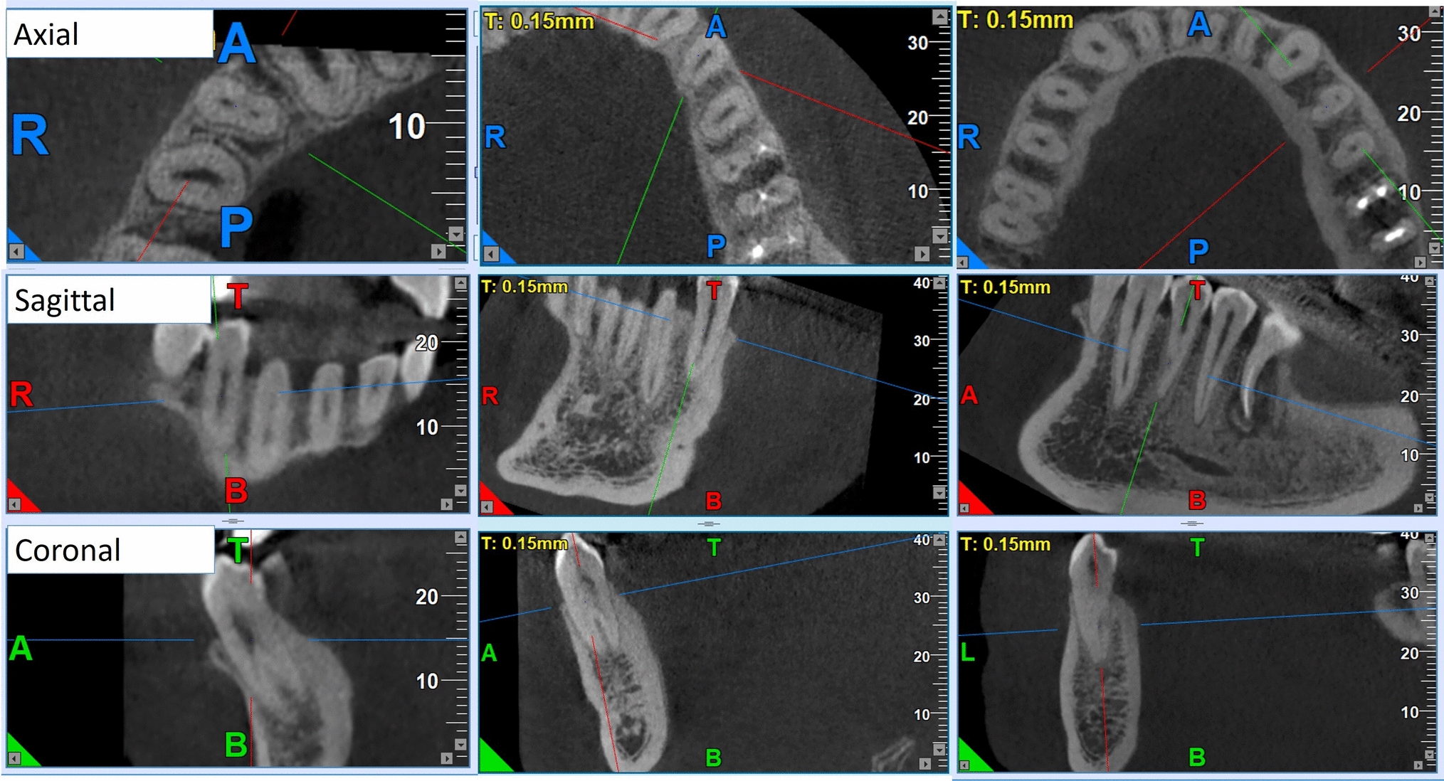 Prevalence of multiple roots and complex canal morphology in mandibular premolars among a selected Southern Egyptian sub-population: a CBCT-analysis