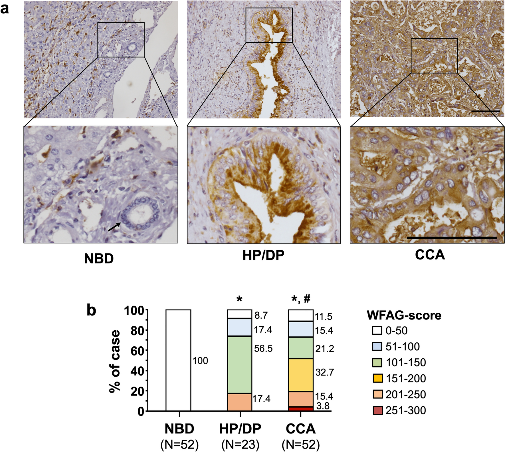 Role of Wisteria floribunda agglutinin binding glycans in carcinogenesis and metastasis of cholangiocarcinoma