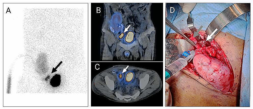 Precise Localization of Urine Leak After Renal Transplantation on Radionuclide Renography: Added Value of the Unclamped Drainage Tube and SPECT-CT