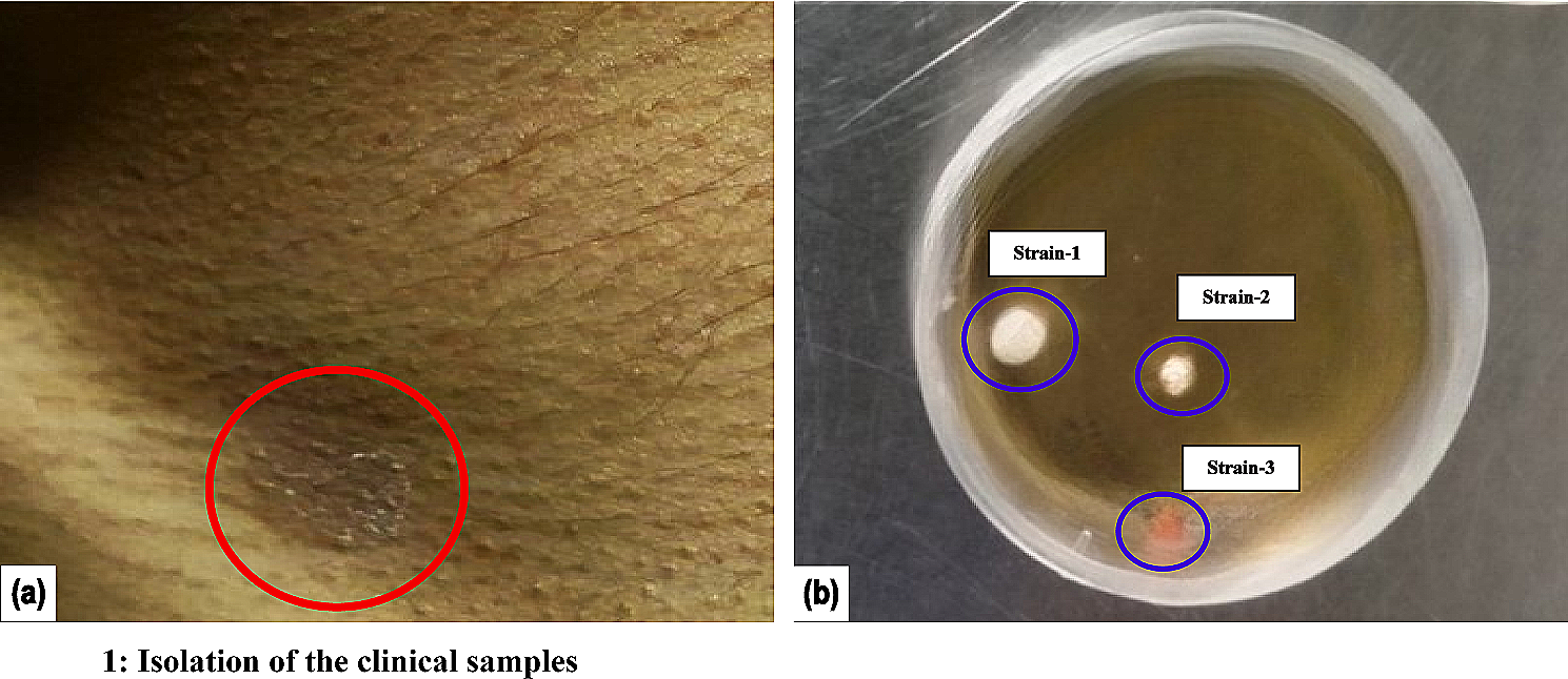 Fungal coexistence in the skin mycobiome: a study involving Malassezia, Candida, and Rhodotorula