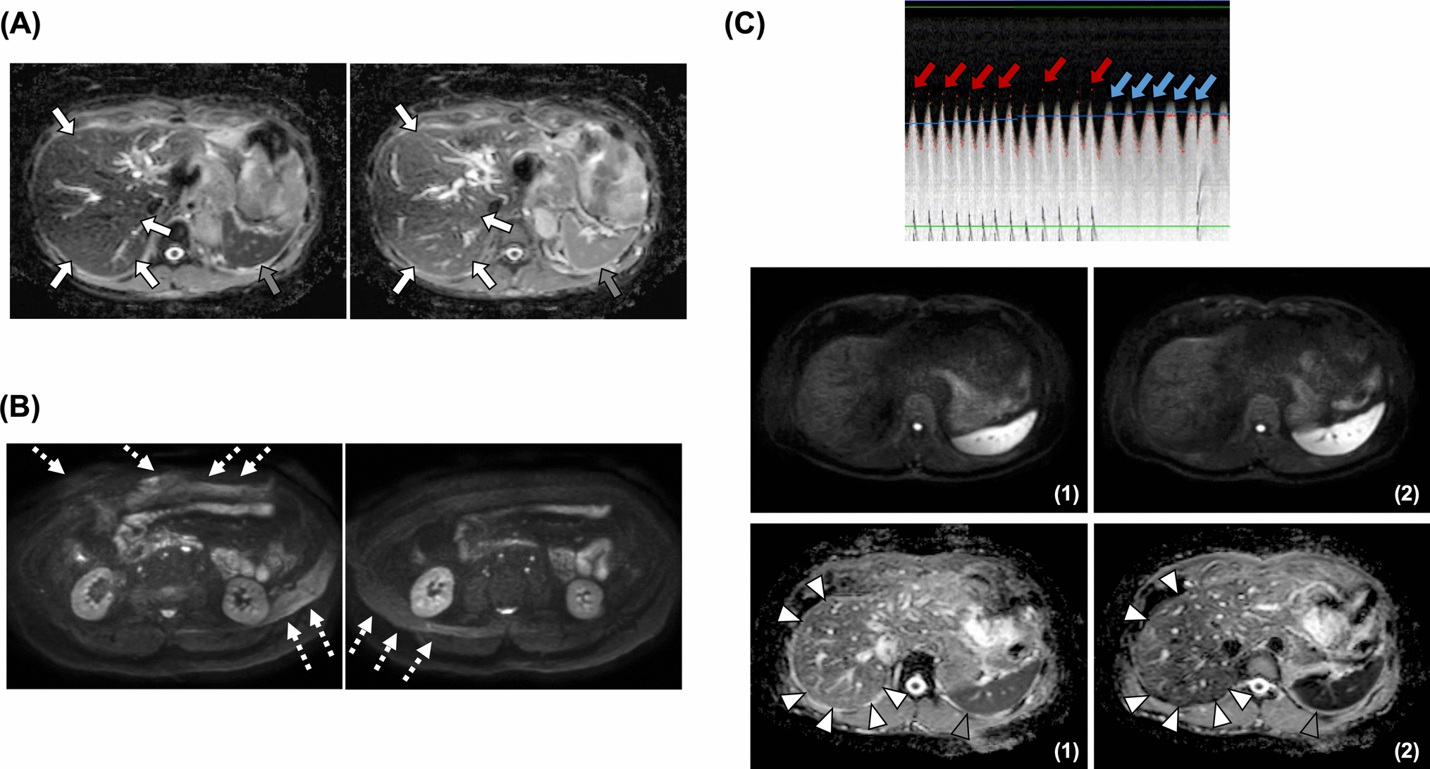 Diffusion weighted imaging combining respiratory triggering and navigator echo tracking in the upper abdomen