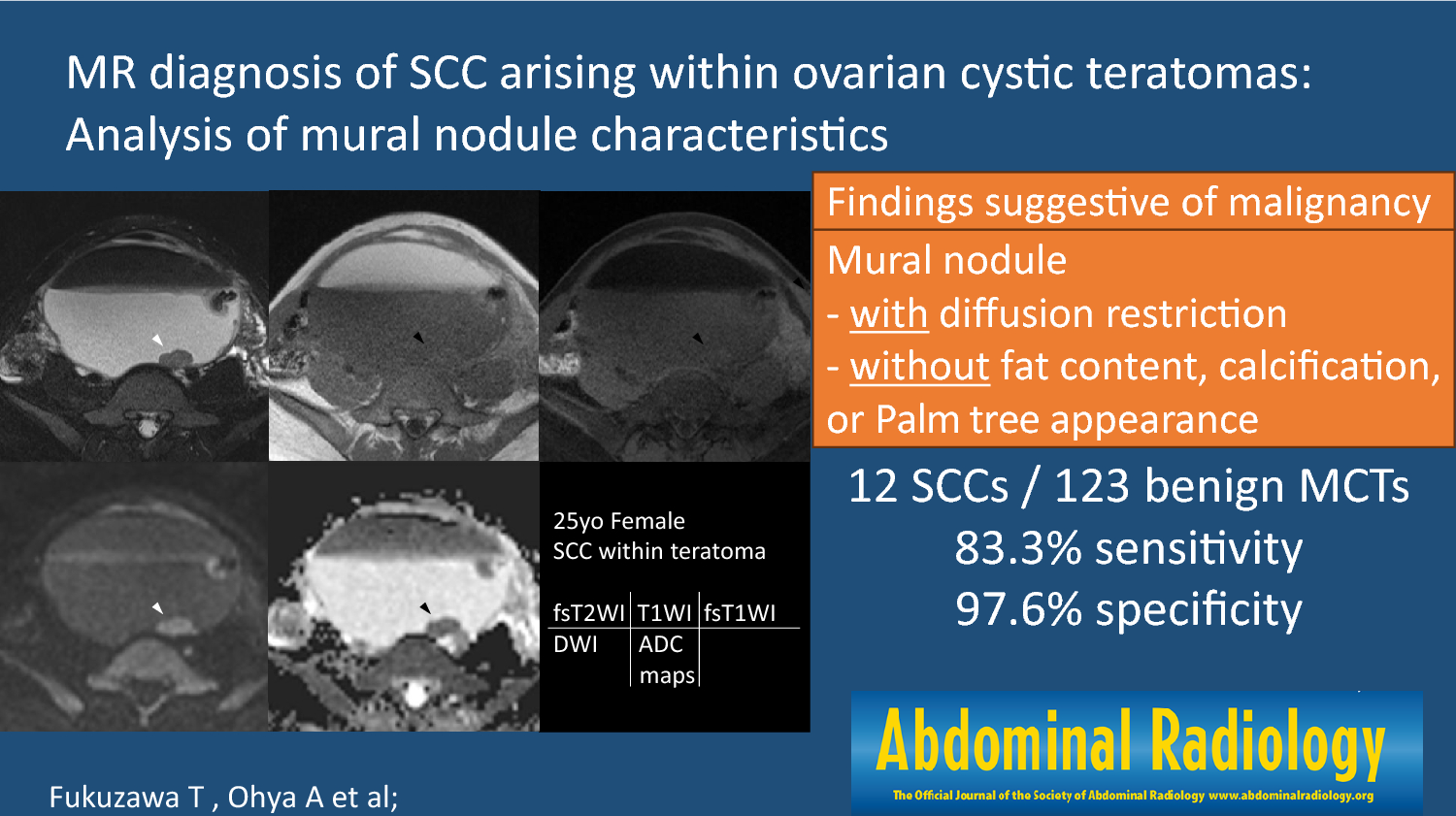 MR diagnosis of SCC arising within ovarian cystic teratomas: analysis of mural nodule characteristics
