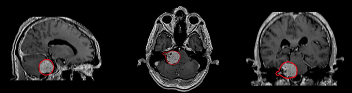 Stereotactic Radiosurgery for Vestibular Schwannoma With Radiographic Brainstem Compression