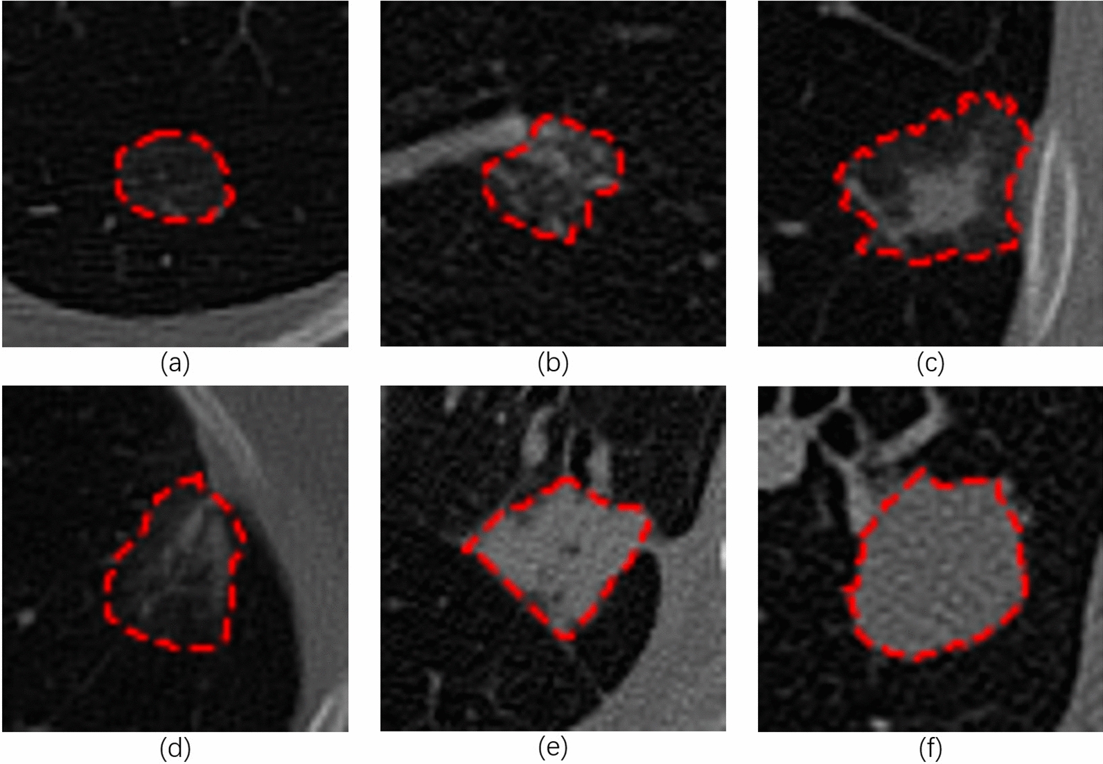 Hierarchical classification of early microscopic lung nodule based on cascade network