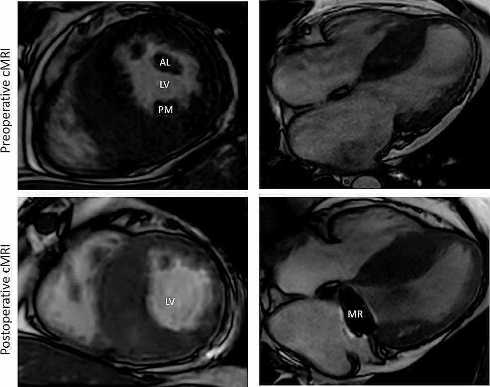 Resection of hypertrophic papillary muscles and mitral valve replacement in a patient with midventricular hypertrophic obstructive cardiomyopathy – a new approach