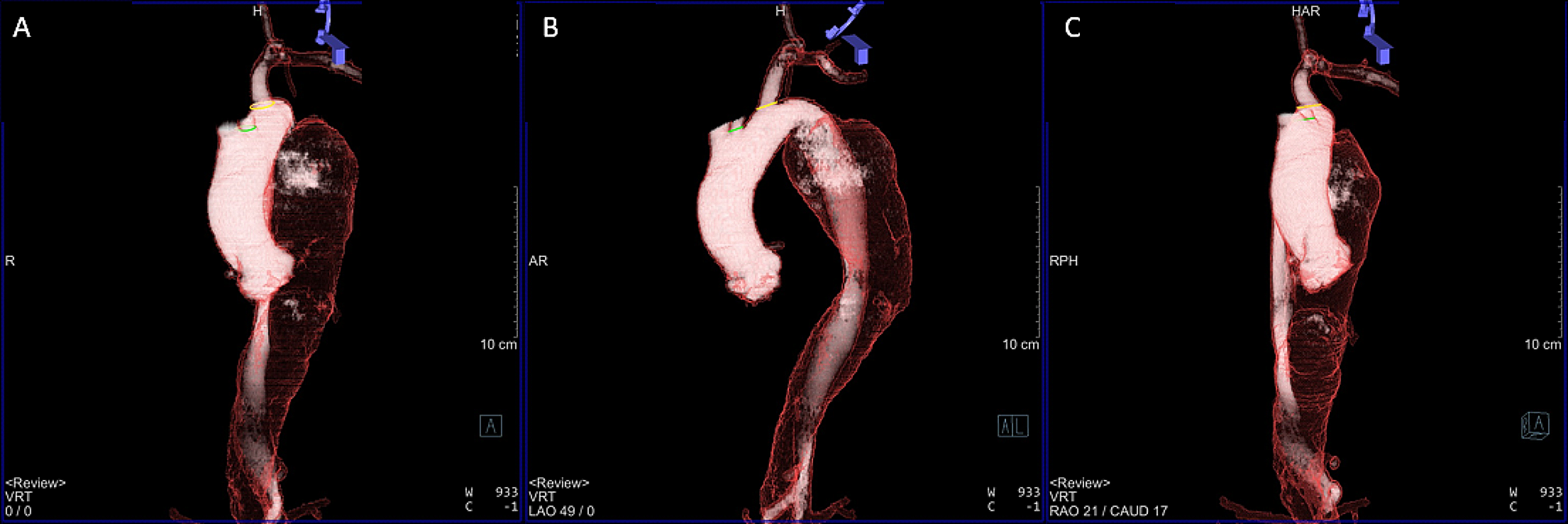 Image fusion guidance for left subclavian artery in situ fenestration during thoracic endovascular repair