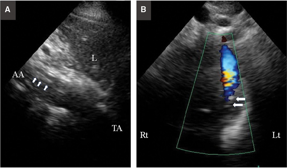 Diagnostic Ultrasound: On-Site Diagnosis of Type B Aortic Dissection During Cataract Surgery