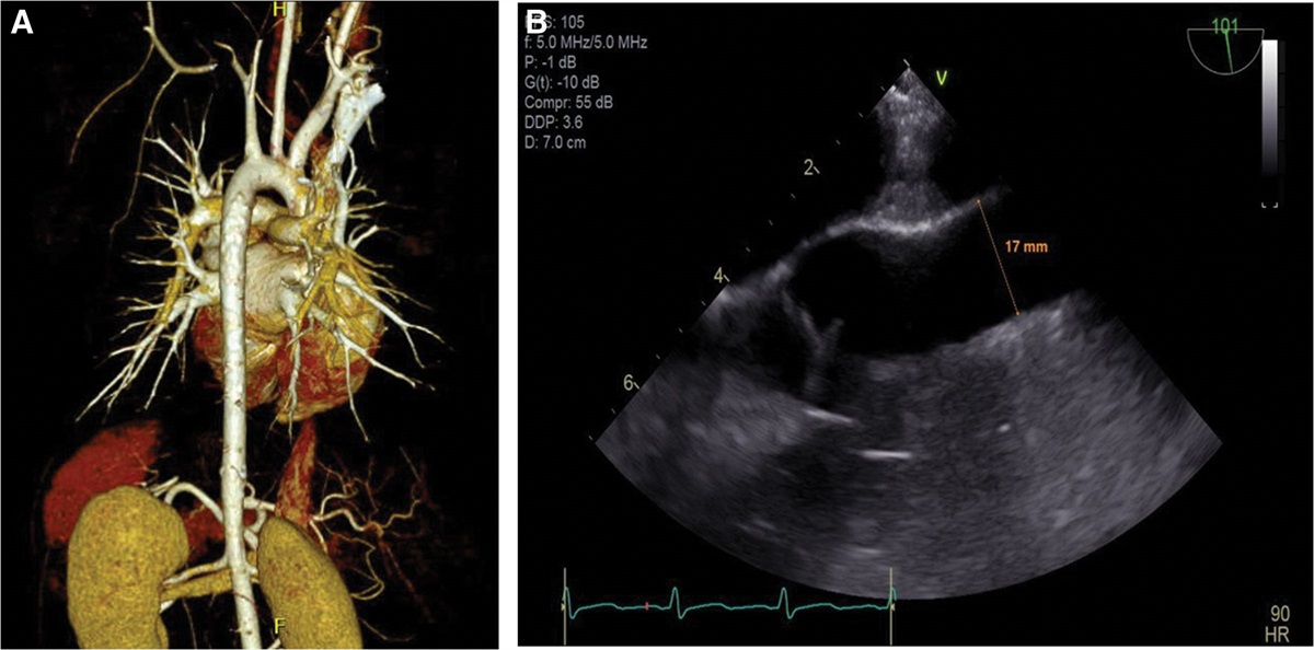 Anesthetic Management of Middle Aortic Syndrome in an Adult: A Case Report