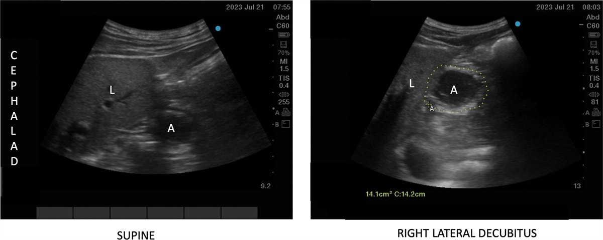 Point-of-Care Gastric Ultrasound to Identify a Full Stomach on a Diabetic Patient Taking a Glucagon-Like Peptide 1 Receptor Agonist