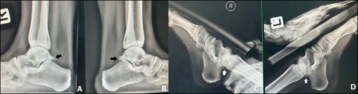 Bilateral Os Trigonum Fracture Treated With Simultaneous Posterior Ankle Arthroscopy