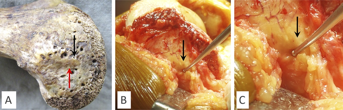 Influence of Preoperative Deformity on Flexion Gap Asymmetry in Measured Resection Technique: A Theoretical Study in Navigated Gap Balancing Total Knee Arthroplasties, Done for Varus Knee Osteoarthritis