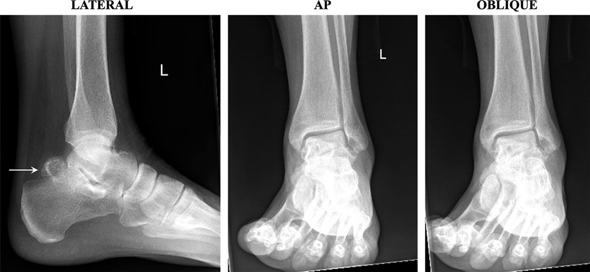 Tarsal Tunnel Syndrome Associated With a Bipartite Talus