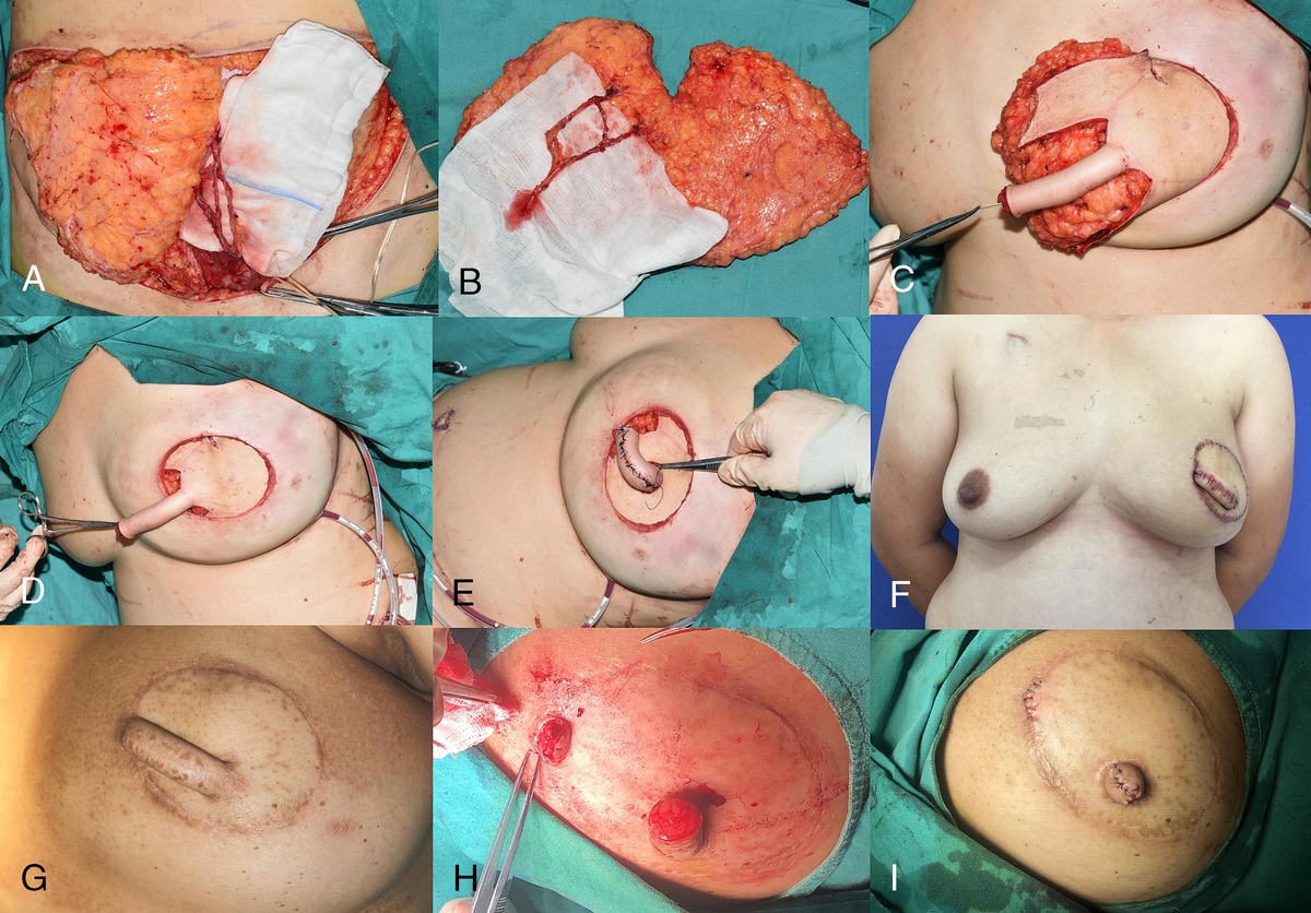 Staged Immediate Nipple Reconstruction With Tube Flap in Immediate Deep Inferior Epigastric Artery Perforator Flap Breast Reconstruction