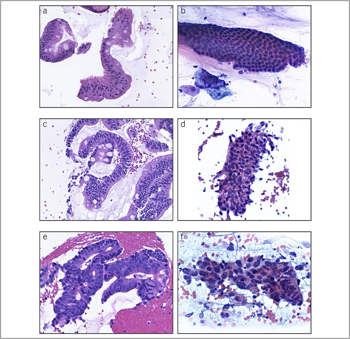 WATS3D: An Interobserver Study of Barrett's Esophagus–Associated Dysplasia Among Gastrointestinal Pathologists