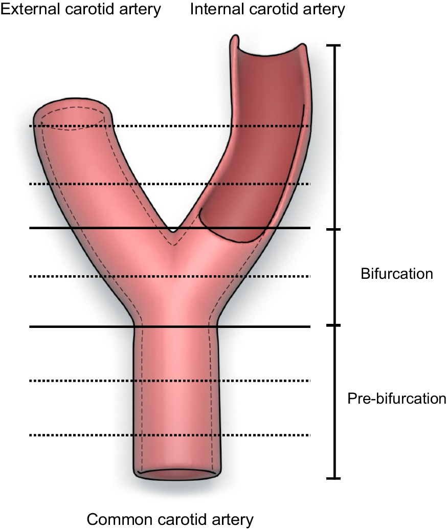 Human nerve distribution and density around the carotid artery bifurcation
