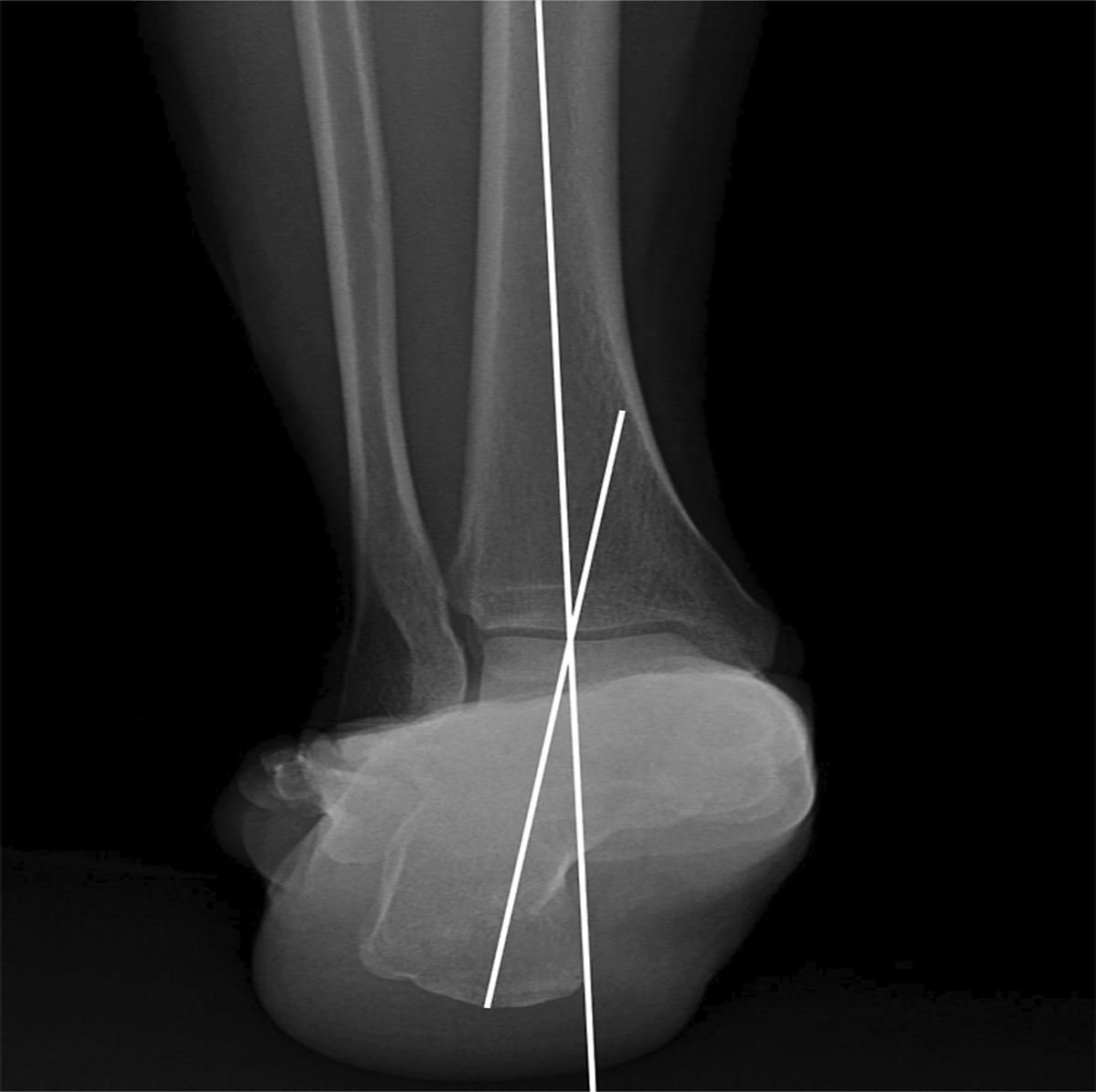 Preoperative Hindfoot Alignment and Outcomes After High Tibial Osteotomy for Varus Knee Osteoarthritis: We Walk on Our Heel, Not Our Ankle