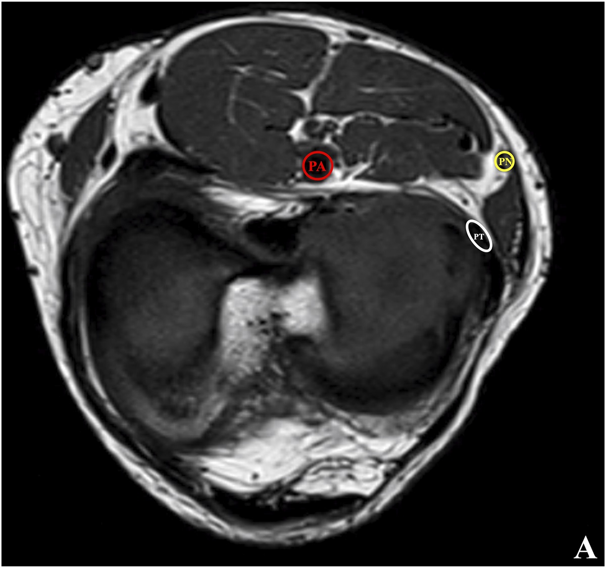 Assessing Risk of Iatrogenic Peroneal Nerve Injury in All-Inside Lateral Meniscal Repair Between Standard Vs. Arthroscopic MRI