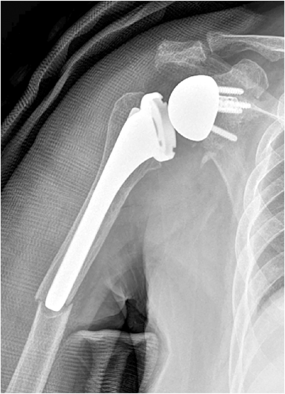 Comparing the Biomechanical Stability of Cerclage Cable with Plate Insert Versus Locking Screw in Periprosthetic Humeral Fracture