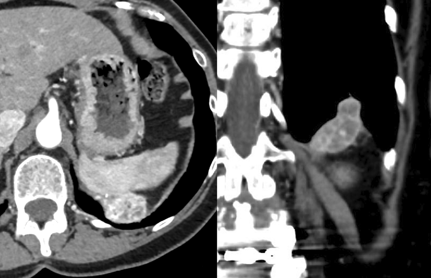 Cryoablation of a Large Diaphragmatic Metastasis with Long-Term Follow-Up