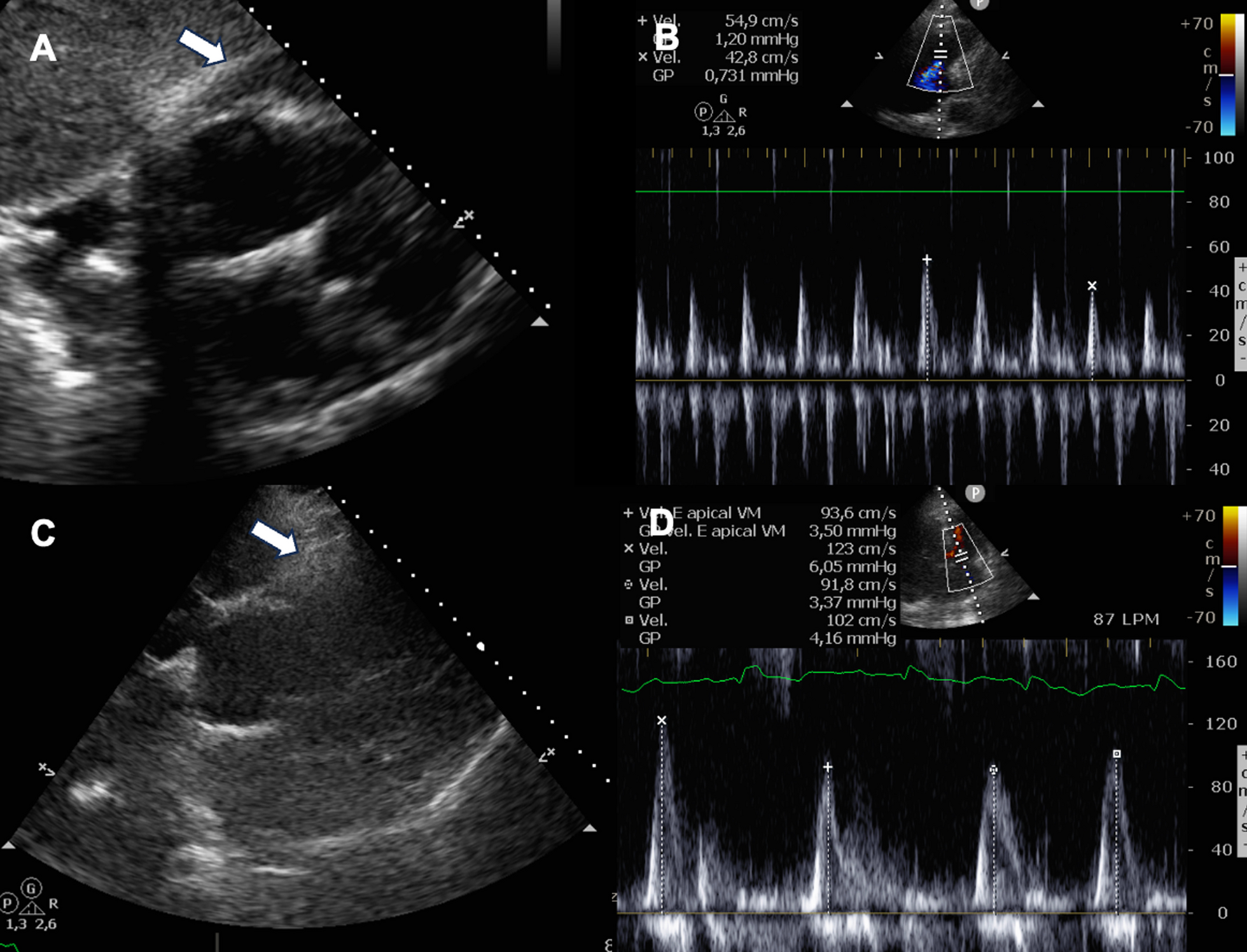 Intra-pericardial thrombin injection in iatrogenic cardiac tamponade: a case report