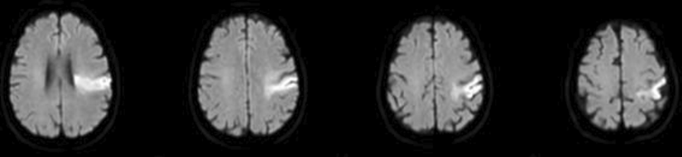 Right-sided alien hand in acute parietal infarction: a case report