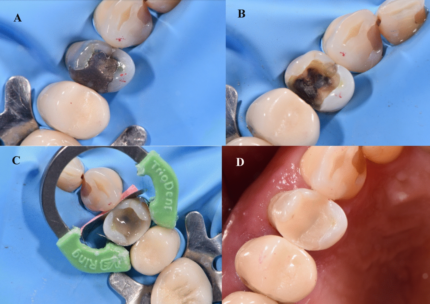 Clinical evaluation of posterior flowable short fiber-reinforced composite restorations without proximal surface coverage