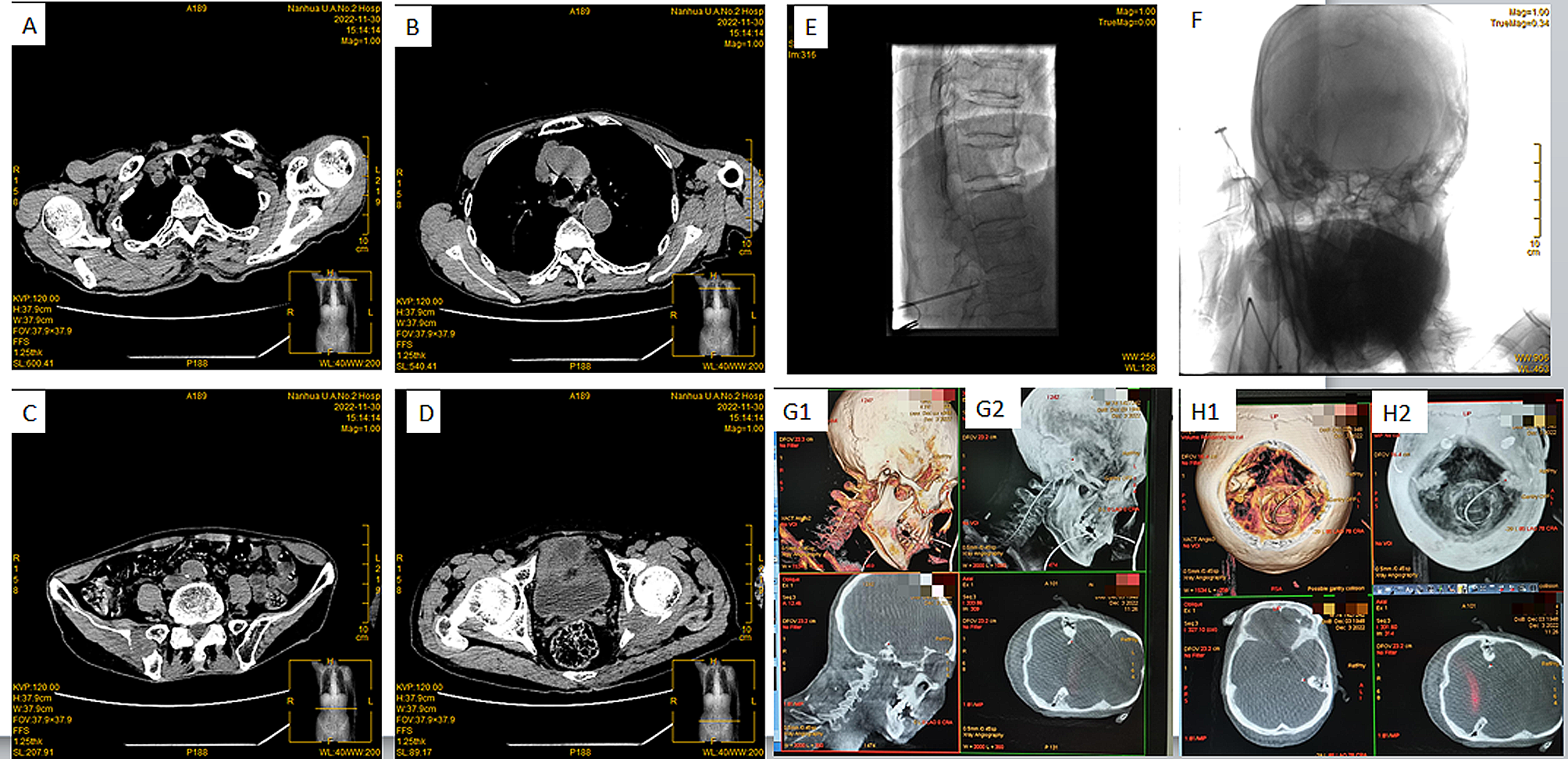 Intrathecal morphine delivery at prepontine cistern to control refractory cancer-related pain: a case report of extensive metastatic and refractory cancer pain