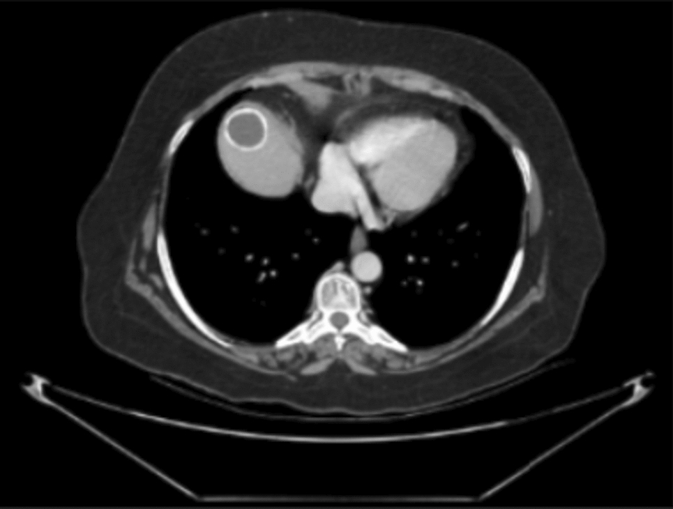 Ovarian Mature Cystic Teratoma with Intraperitoneal Lesions, an Unusual Presentation: A Case Report