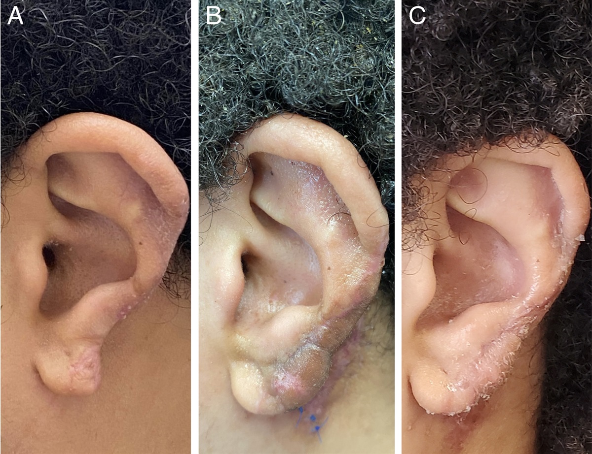 Partial Reconstruction of the Auricle With the Tubed Postauricular Flap: A Case Report and Proposed Innovation for Flap Conditioning