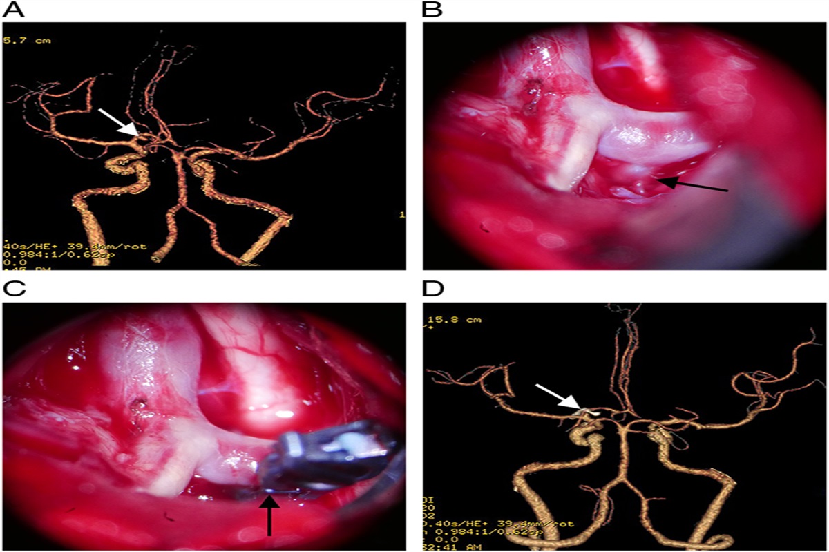 Prognostic Factors for Anterior Cerebral Artery Aneurysms: A Single-Center Series