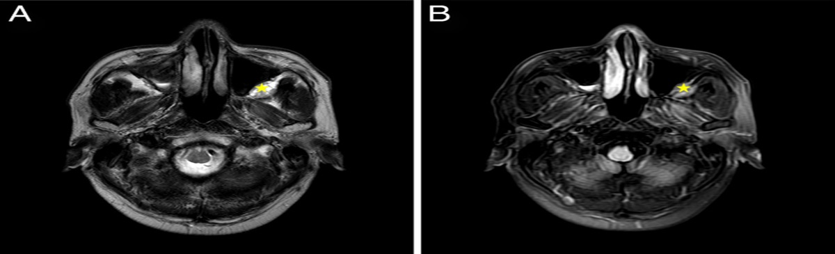 Infratemporal Fossa Schwannoma Surgery via a Combined Prelacrimal Recess, Caldwell-Luc, and Distal Intraoral Approach