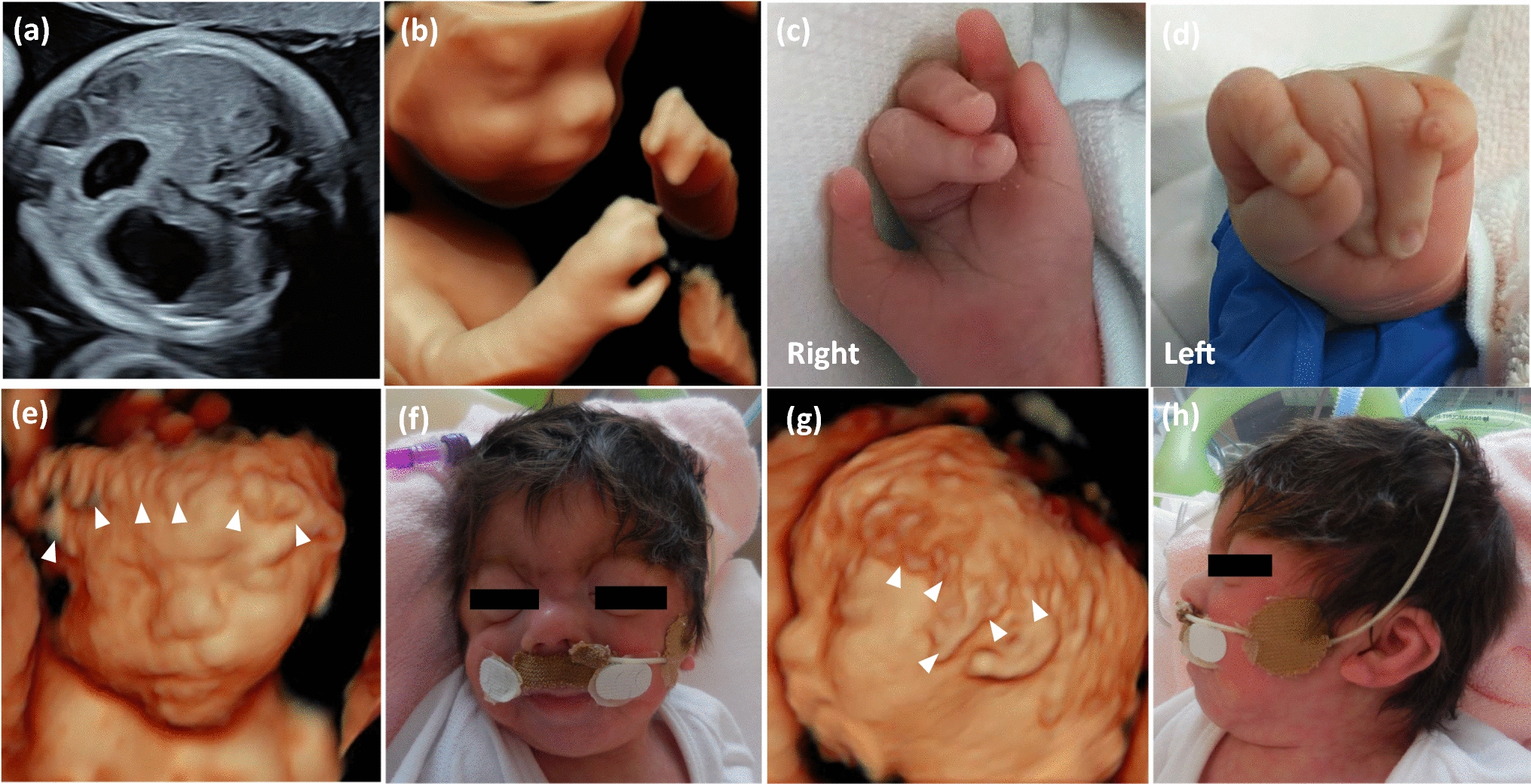 Three-dimensional sonographic images of fetal hirsutism: prenatal characteristic features in cornelia de lange syndrome