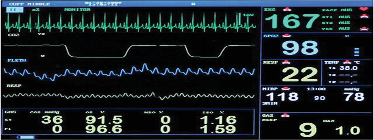 Application of End-Tidal CO2 Monitoring to ICU Management