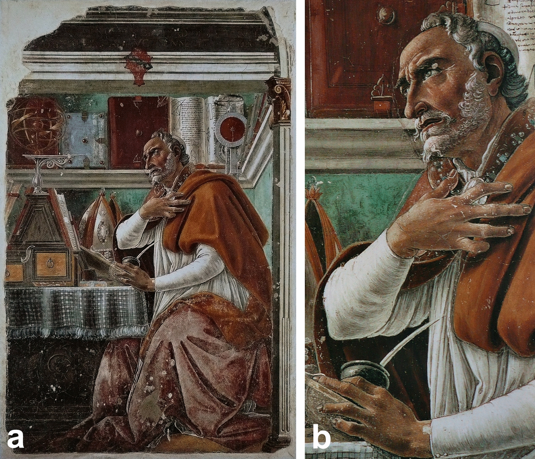 Saint Augustine in his studio by Sandro Botticelli (1445–1510): a representation of Hemochromatosis?