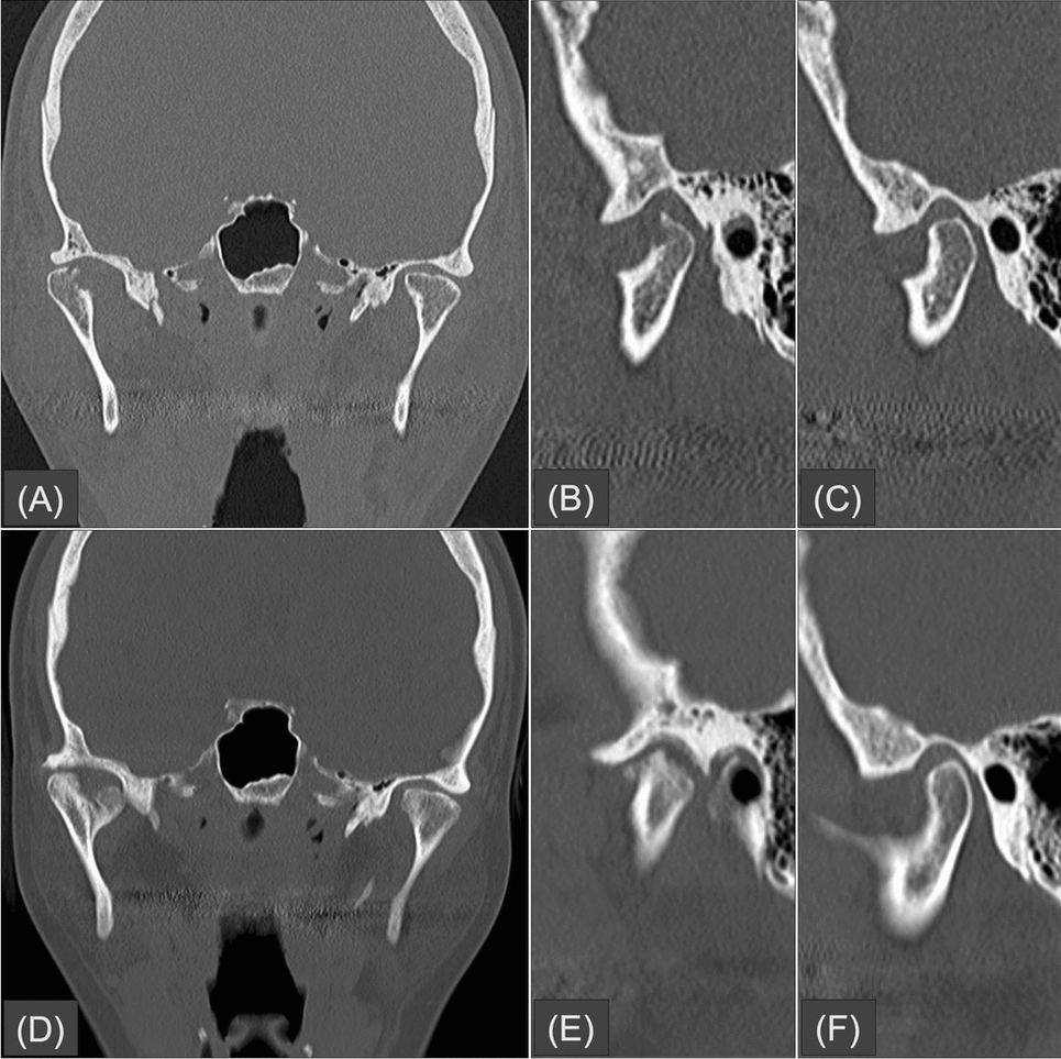 Temporomandibular joint degenerative changes following mandibular fracture: a computed tomography-based study on the role of condylar involvement