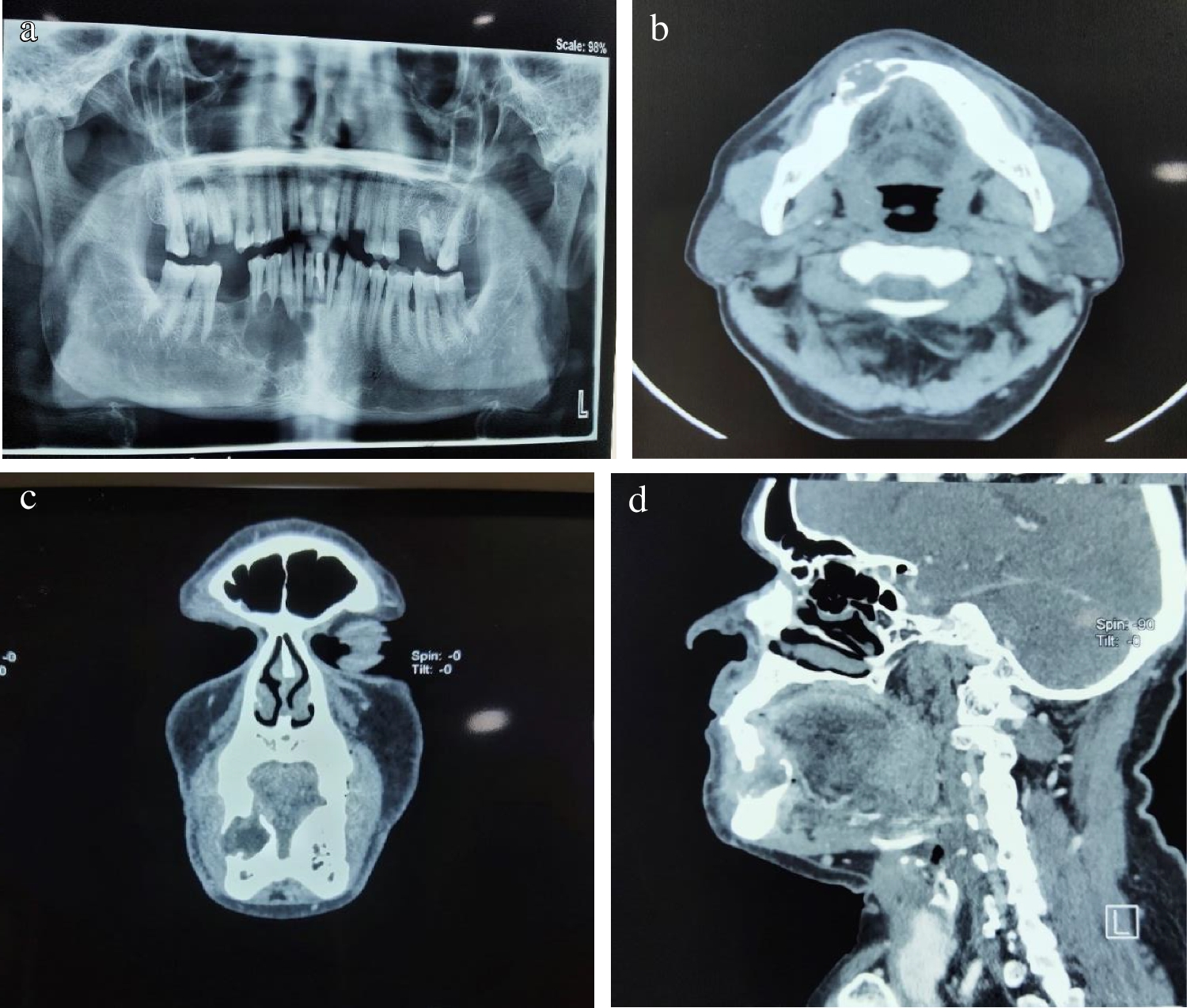 Clinical, Radiological, and Pathological Correlation of Mandibular Invasion in Carcinoma Bucco-alveolar Complex
