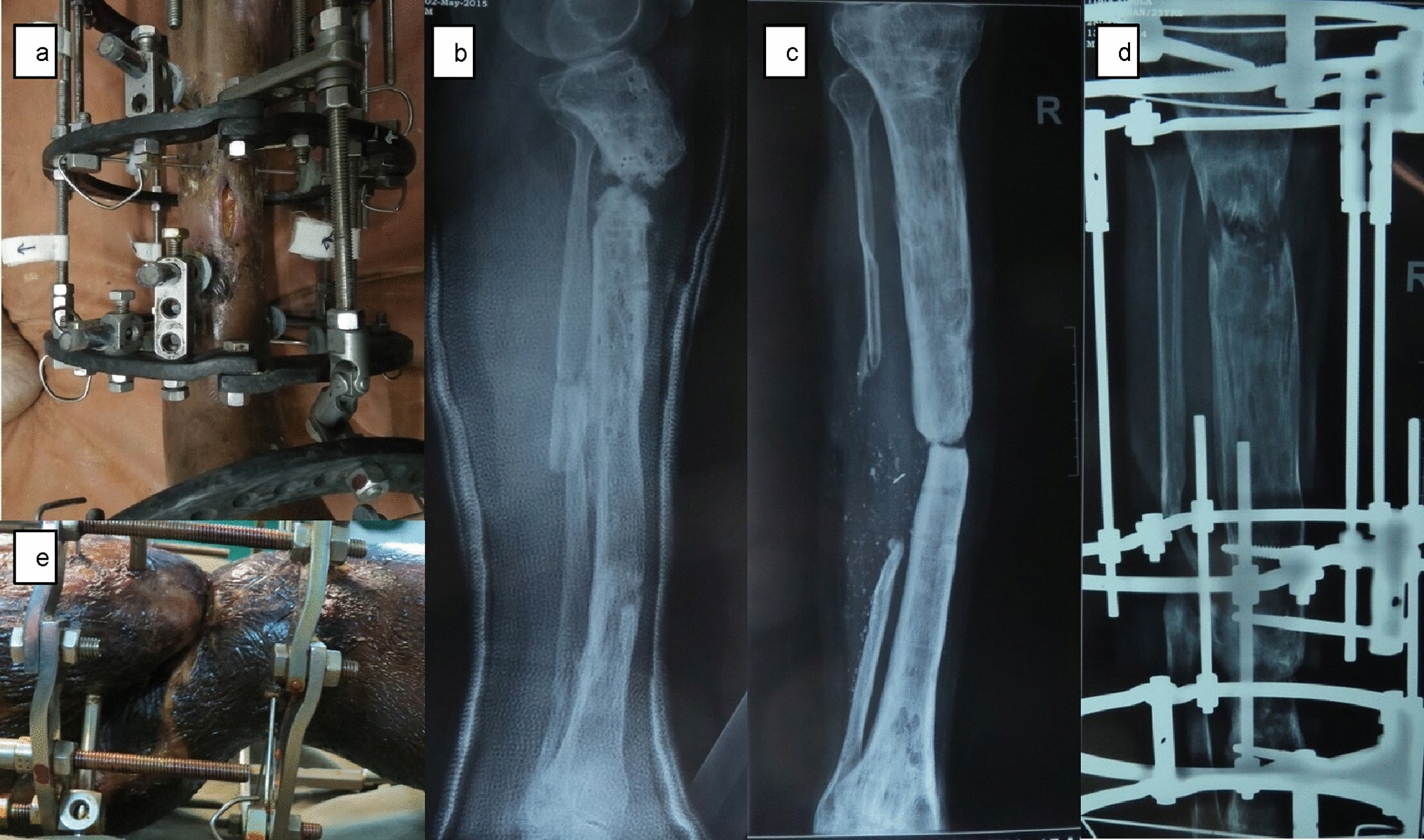 Outcome of Bone Transport Using Ilizarov External Fixator in Infected Non-union of Tibia with Large Bone Defects: Comparison of Those with 5–10 cm Bone Defect with Those Having ≥ 11 cm Bone Defect